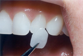 Porcelain (Laminate Dental Veneers)